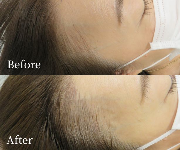 ヘアタトゥー（ヘアライン正面生え際全部）症例写真ビフォー・アフター