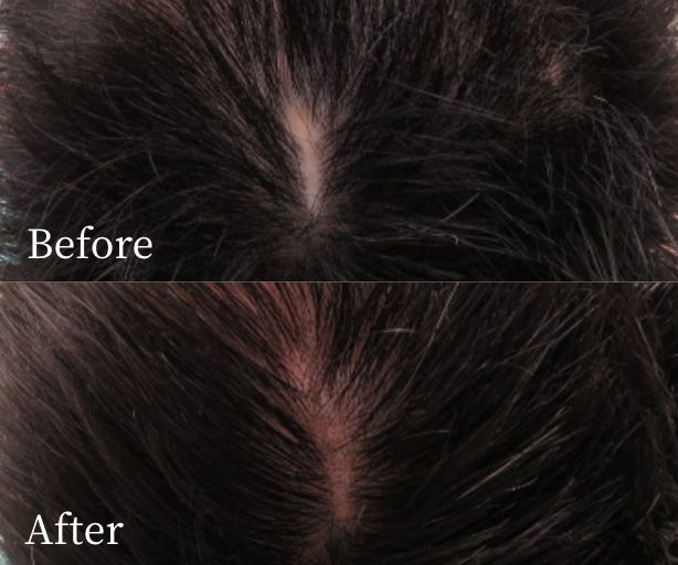 ヘアタトゥー（ポイント）症例写真ビフォー・アフター