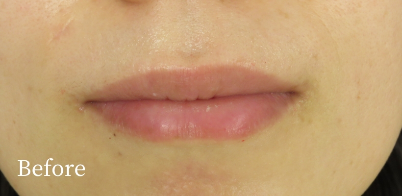 リップアートメイク（フルリップ）症例写真ビフォー
