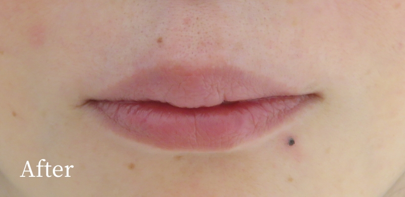 ほくろアートメイク症例写真アフター