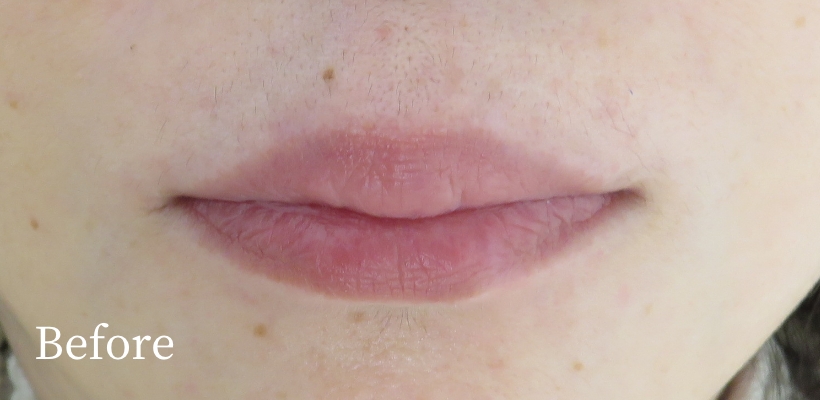 ほくろアートメイク症例写真ビフォー