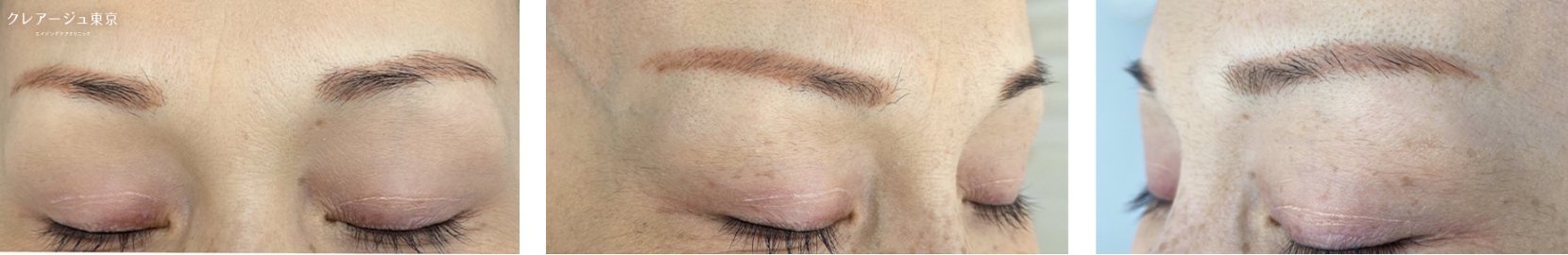 症例写真_Aさん（40代後半） Before