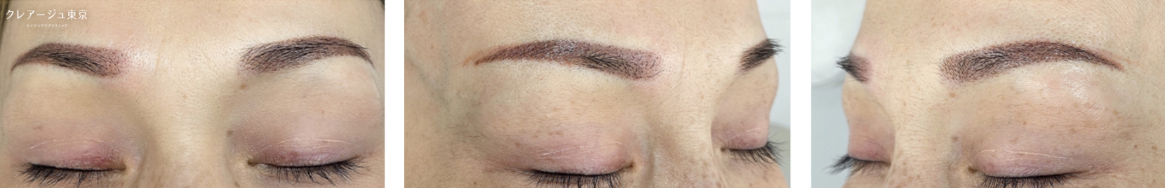 症例写真_Aさん（40代後半） After