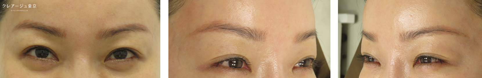 症例写真_Yさん（40代前半） Before