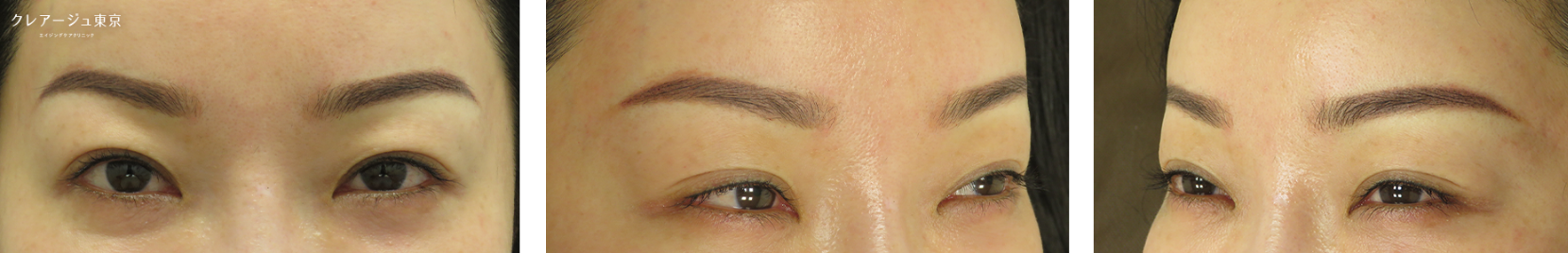 症例写真_Yさん（40代前半） After