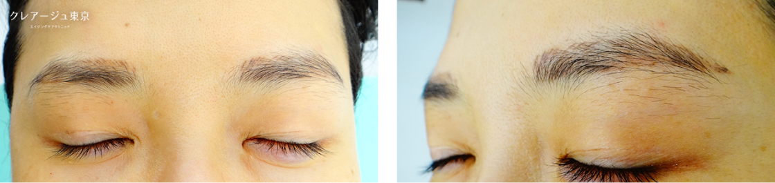 症例写真_Yさん（40代前半） Before