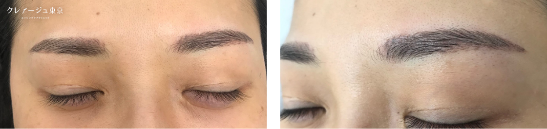 症例写真_Yさん（40代前半） After