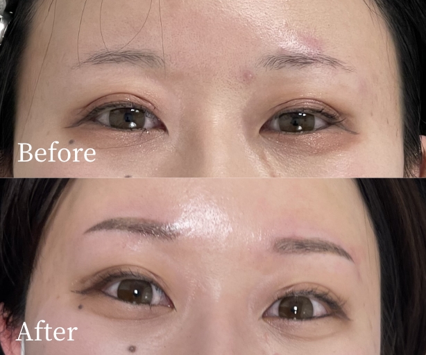 眉アートメイク（コンビネーション）症例写真ビフォー・アフター