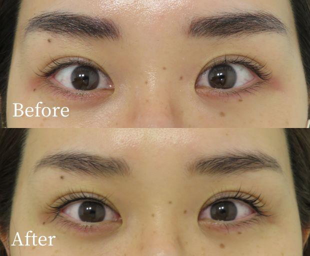 アイライン上アートメイク症例画像(ビフォーアフター)