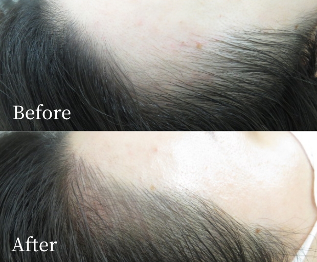 ヘアラインアートメイク症例画像(ビフォーアフター)