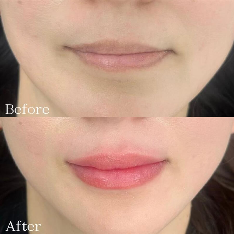 フルリップアートメイク症例画像(ビフォーアフター)